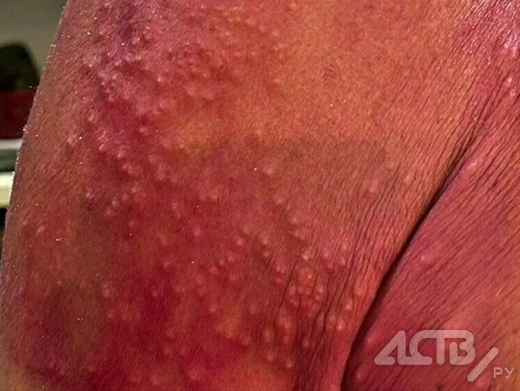 Изображение На Сахалине появились страшные обжигающие кожу медузы